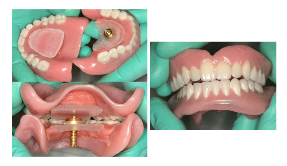 A Smarter Way to Record Jaw Relations: Predictable & Repeatable Results