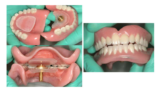 A Smarter Way to Record Jaw Relations: Predictable & Repeatable Results