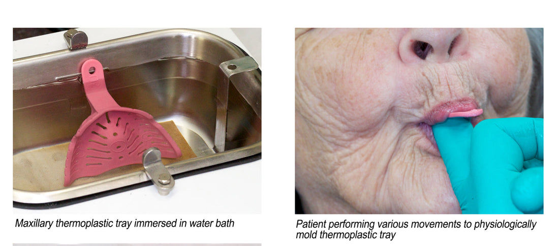 Mastering the Art of Edentulous Impressions with Massad Trays