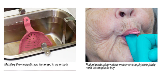 Mastering the Art of Edentulous Impressions with Massad Trays
