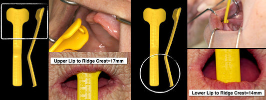 Example of measurements taken with a yellow lip ruler